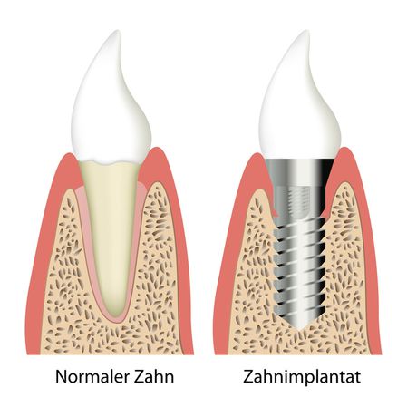 Natürliche Zahnwurzel und Zahnwurzelimplantat